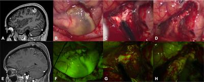 Fluorescein sodium in the surgical treatment of pleomorphic xanthoastrocytomas: Results from a retrospective study